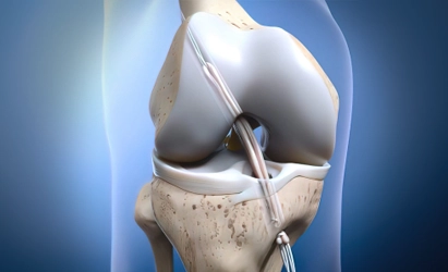 ACL Ligament Reconstruction Surgery in Hyderabad